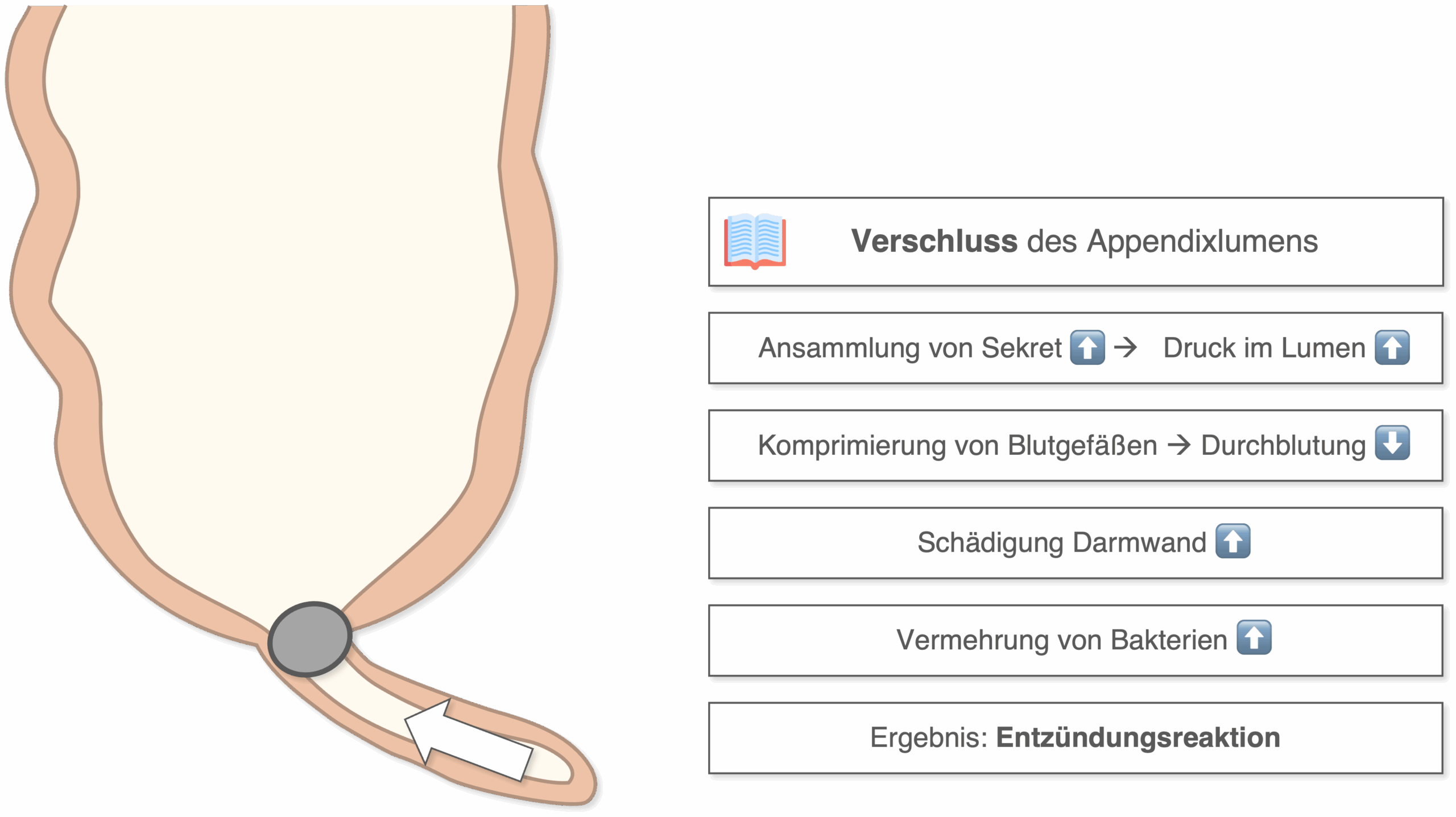 Appendizitis - Pathophysiologie