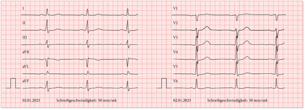 Beispiel EKG