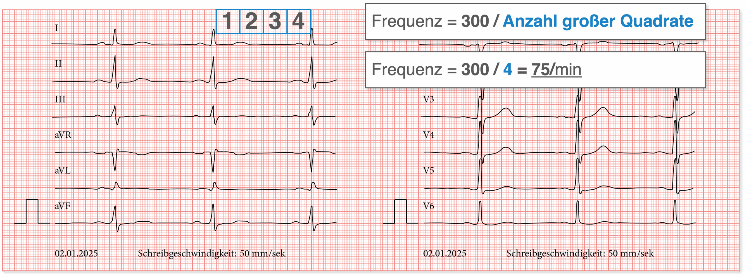 EKG - Frequenz bestimmen