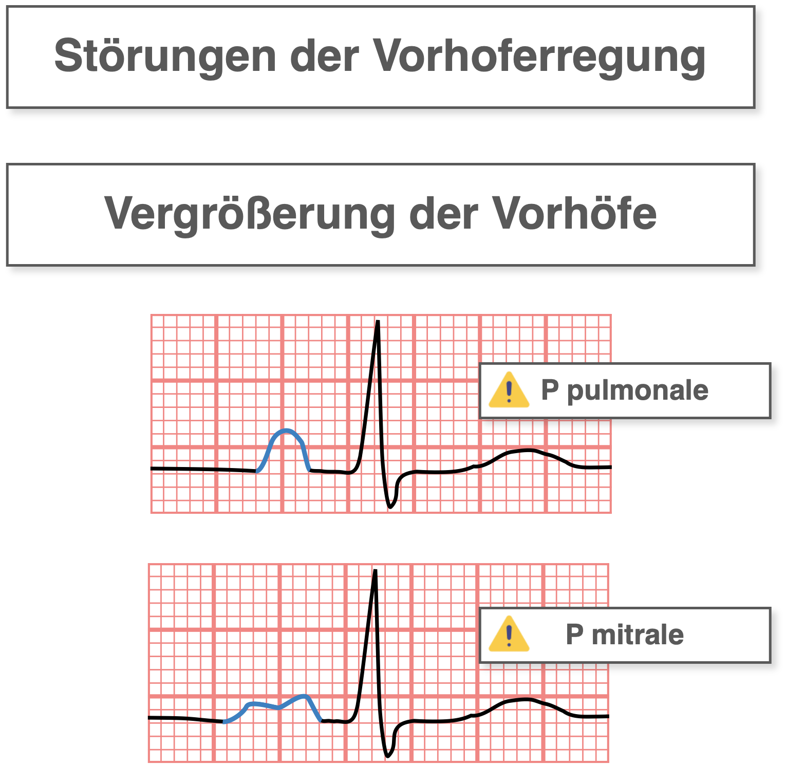 P-Welle - Pathologien