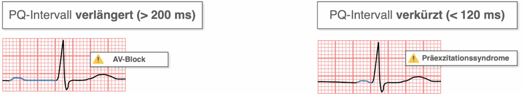 PQ-Interval - Pathologien