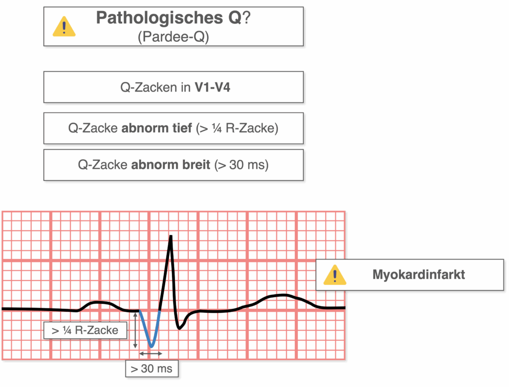 Q-Zacke - Pathologien (Pardee-Q)