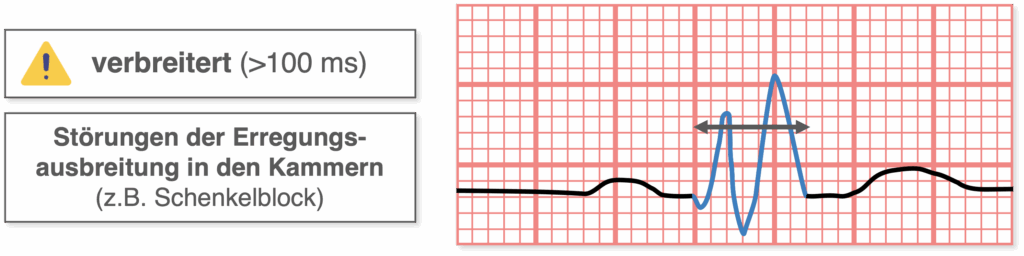 QRS-Komplex - Pathologien