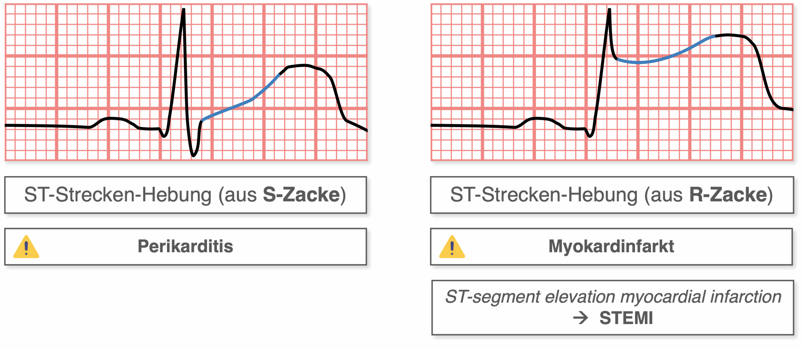 ST-Strecken-Hebung