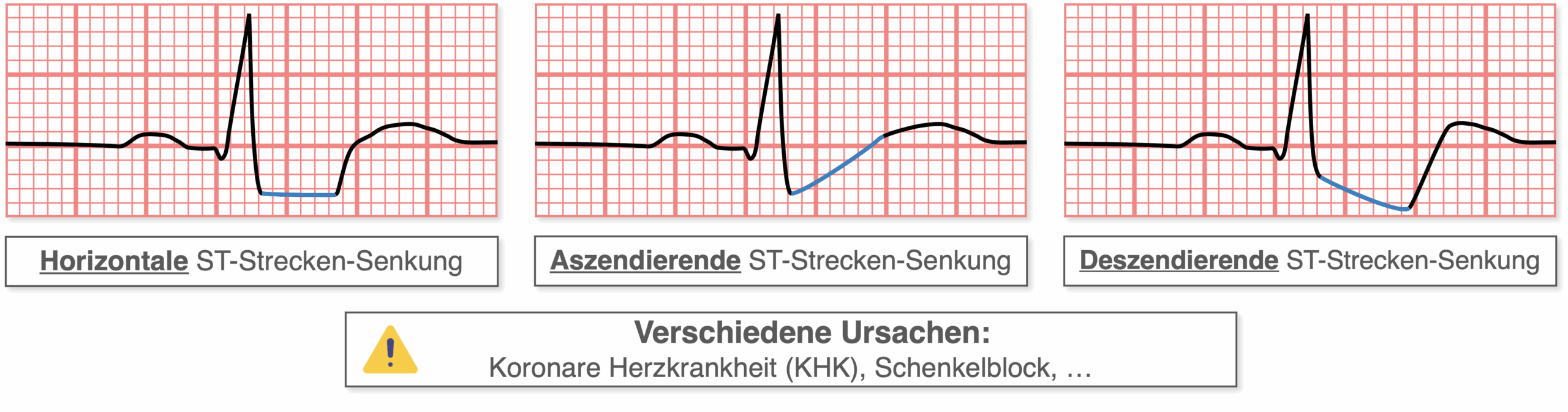 ST-Strecken-Senkung