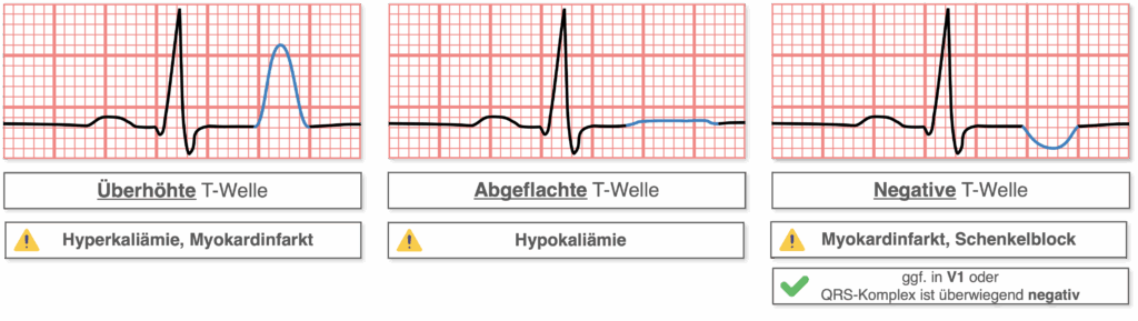 T-Welle - Pathologien