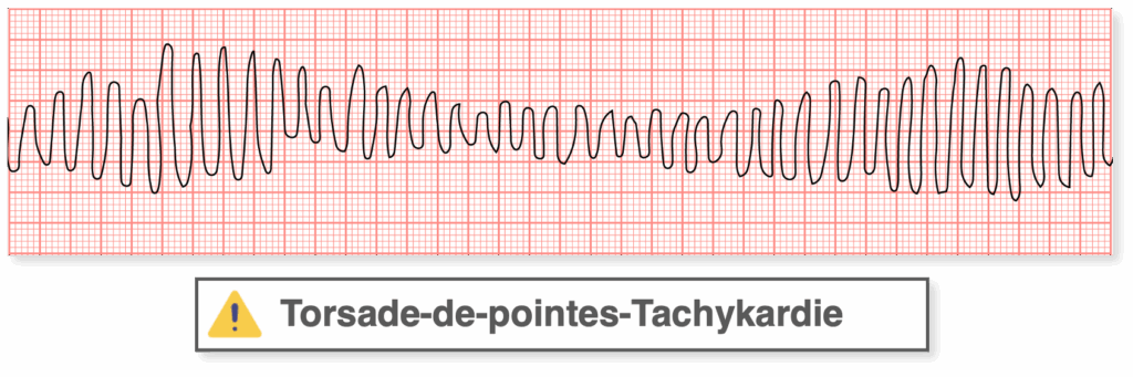 Torsade de pointes Tachykardie