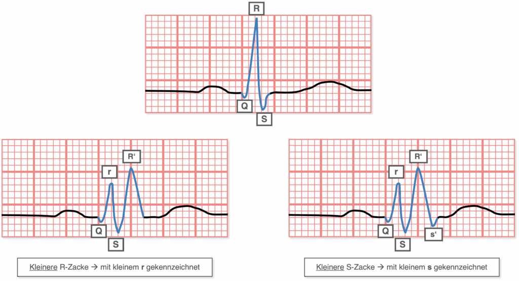 QRS-Komplex und Nomenklatur zusätzlicher Ausschläge