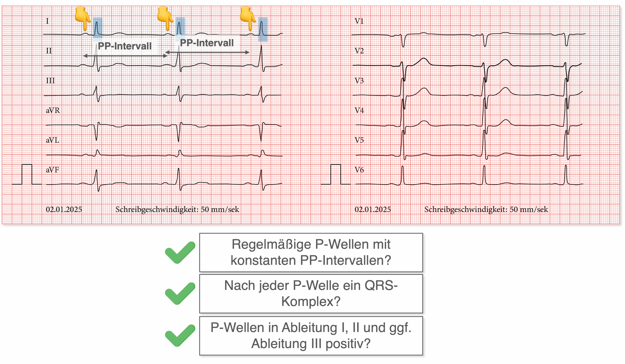 Sinusrhythmus Kriterien