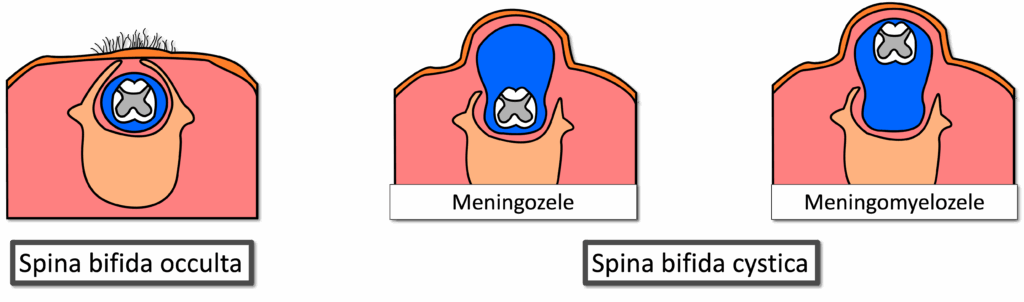 Spina bifida - Übersicht
