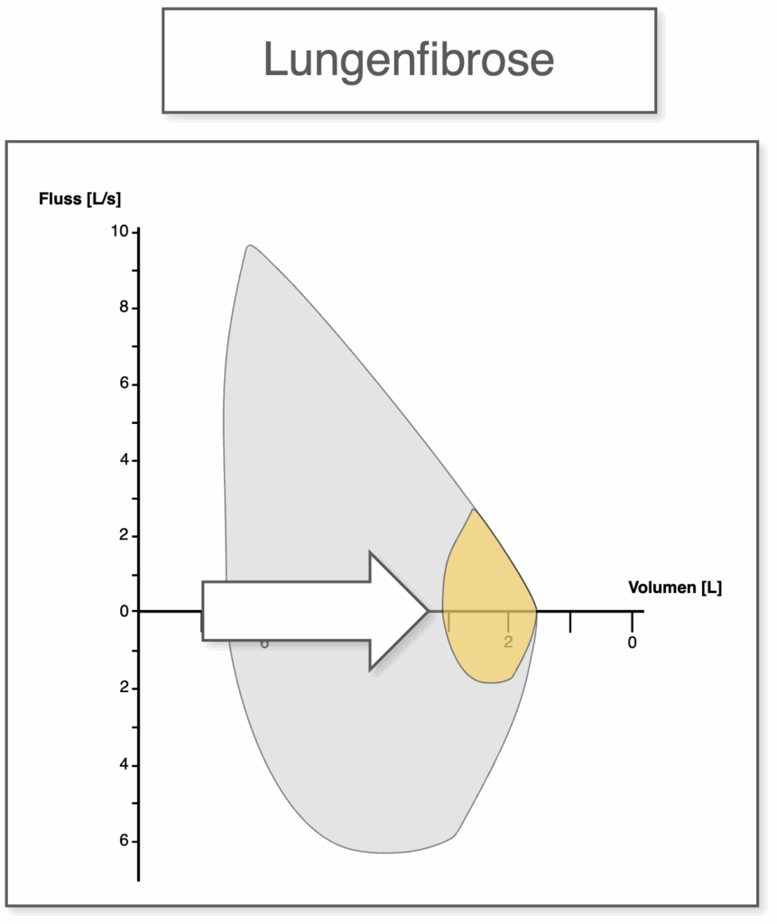 Fluss-Volumen-Kurve - Lungenfibrose