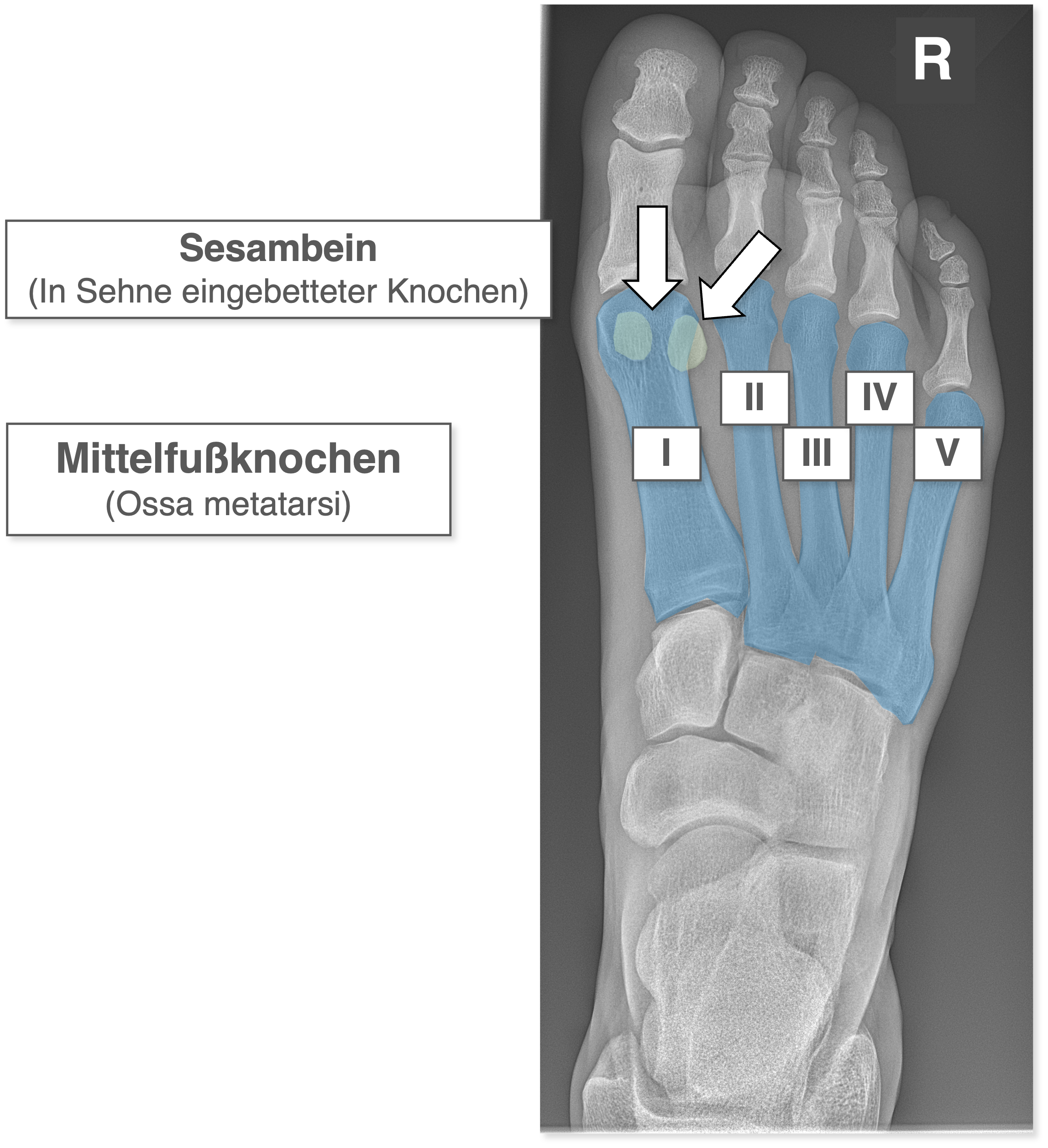 Fuß Röntgenbild - Mittelfußknochen