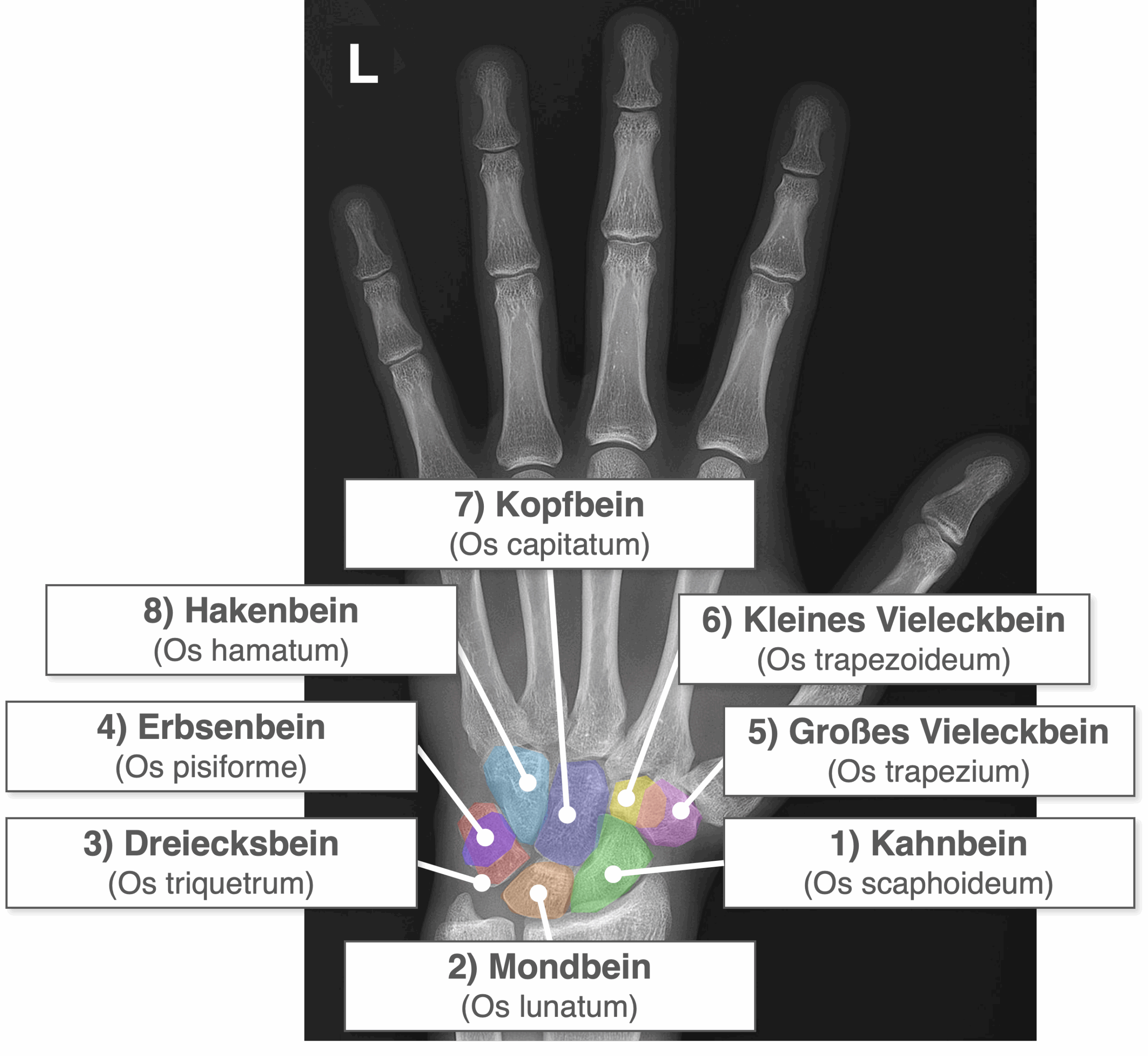 Hand Röntgenbild - Handwurzelknochen