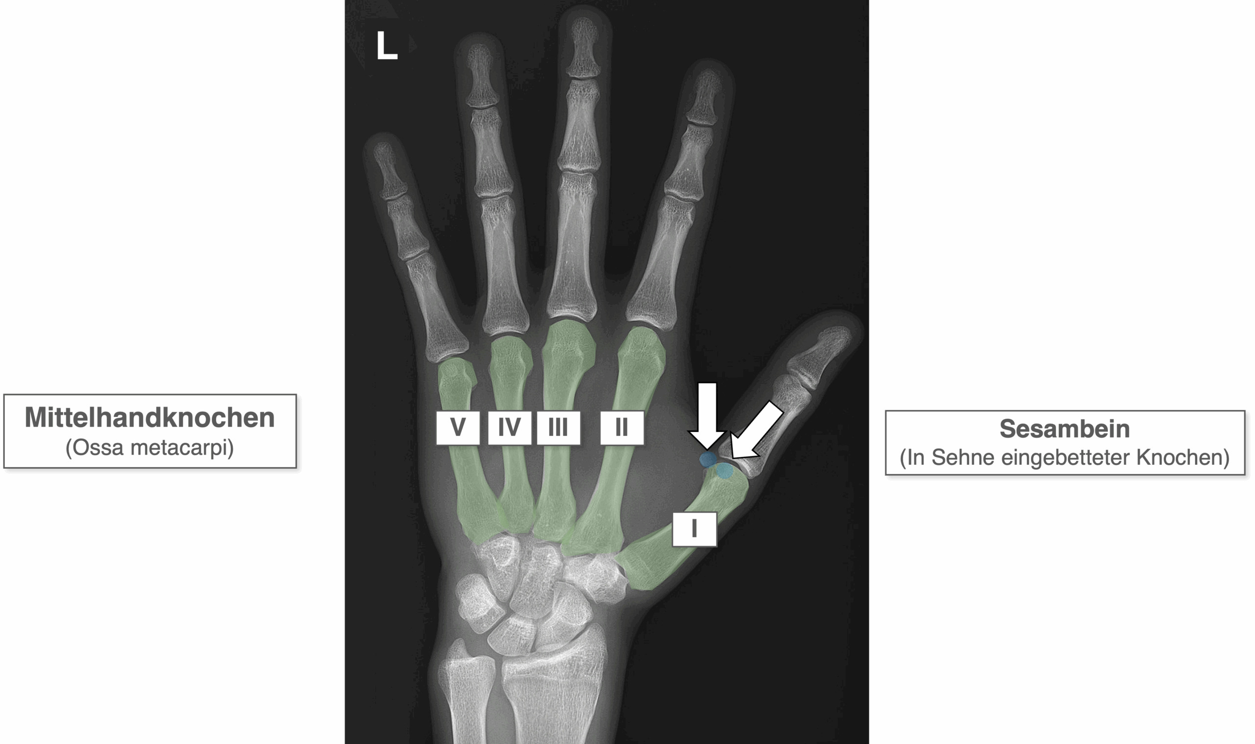 Hand Röntgenbild - Mittelhandknochen