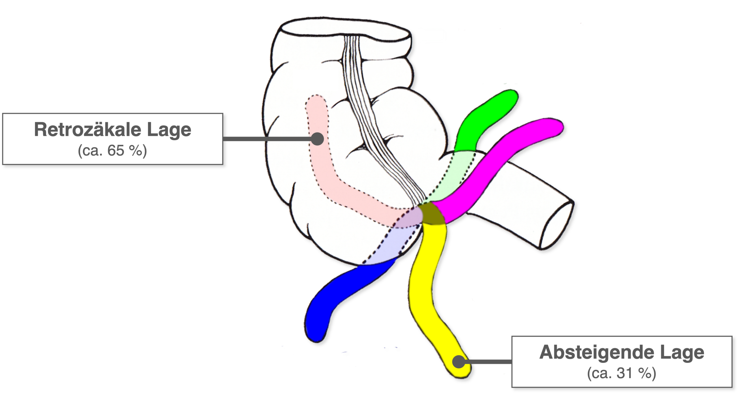 Appendix vermiformis - Lagevarianten